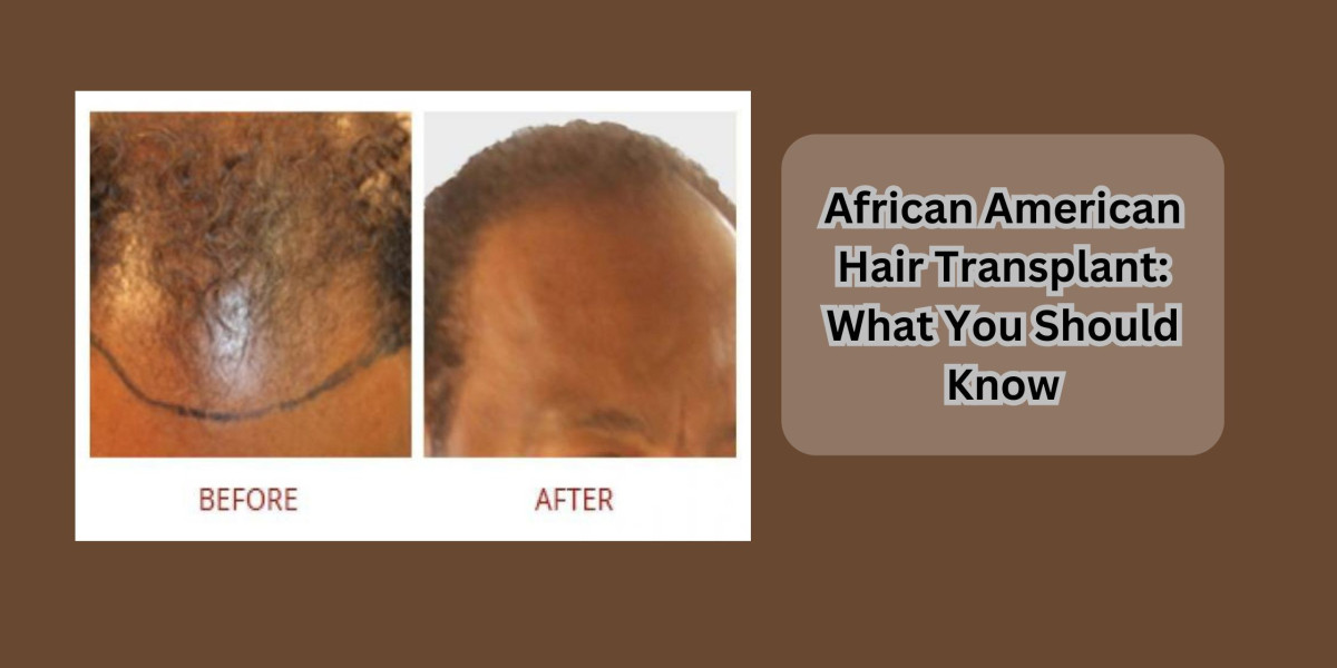 African American Hair Transplant: What You Should Know